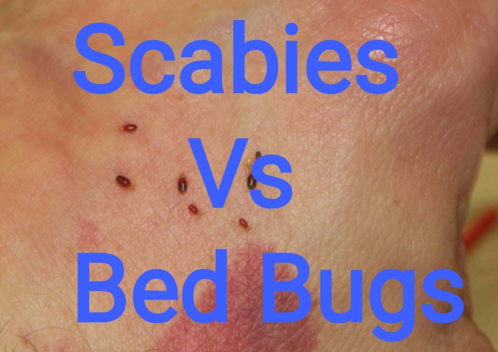 Bed Bug Bites Vs Scabies